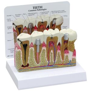 Anatomisch model voor tandheelkundige pathologieën ST-ATM 12