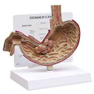 Anatomisch maagmodel pathologie ST-ATM 78